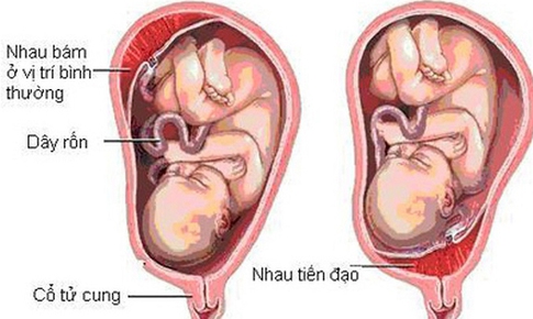 Nhau tiền đạo: Nguy&#234;n nh&#226;n, triệu chứng, c&#225;ch điều trị v&#224; ph&#242;ng ngừa