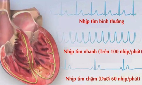 Nhịp tim chậm c&#243; nguy hiểm kh&#244;ng?