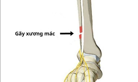 G&#227;y xương m&#225;c n&#234;n tập luyện như thế n&#224;o?