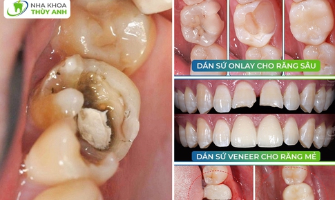 80% răng s&#226;u vỡ nặng vẫn điều trị bảo tồn được bằng c&#225;ch n&#224;y