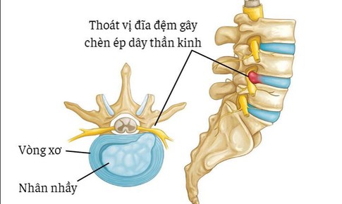 Đau lưng dưới do ngồi nhiều l&#224;m sao ph&#242;ng tr&#225;nh?