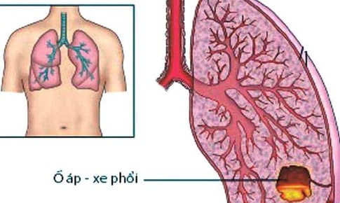 &#193;p xe phổi ai dễ mắc?