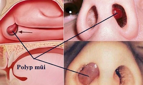 C&#226;u hỏi thường gặp li&#234;n quan đến bệnh polyp mũi