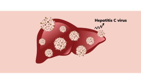 Kế hoạch điều trị vi&#234;m gan virus C ở người nhiễm HIV