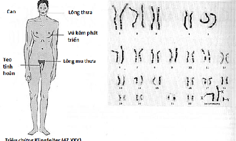Hội chứng XYY c&#243; chữa được kh&#244;ng?