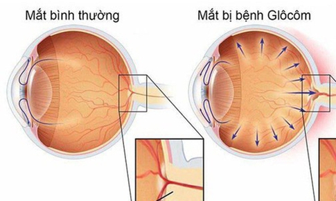 Mắt đỏ cảnh b&#225;o mắc bệnh g&#236;, c&#243; ph&#242;ng ngừa được kh&#244;ng?