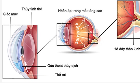 6 bước ngăn ngừa tăng nh&#227;n &#225;p g&#226;y hại th&#234;m cho thị lực