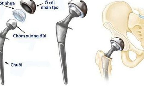 C&#225;c phương ph&#225;p điều trị hoại tử chỏm xương đ&#249;i