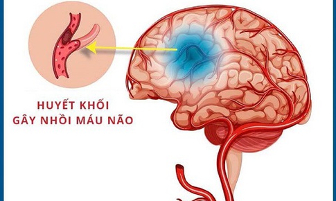 Ai c&#243; nguy cơ đột quỵ nhồi m&#225;u n&#227;o?