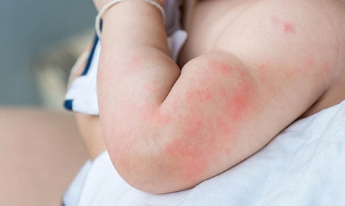 Mày đay ở trẻ em cần xử trí ra sao?