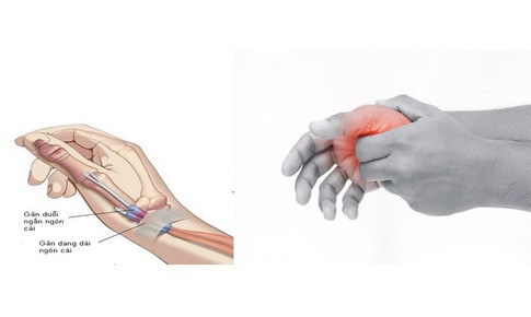 Đau cổ tay lan ra ng&#243;n c&#225;i l&#224; bệnh g&#236;?