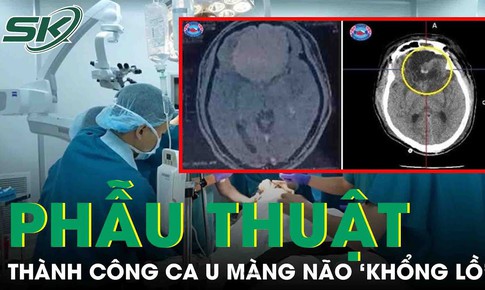 Đau đầu, chóng mặt, vào viện phát hiện khối u màng não 'khổng lồ'