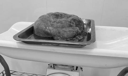 Th&#224;nh c&#244;ng cắt bỏ khối u buồng trứng nặng 2 kg v&#224; ruột thừa vi&#234;m cấp