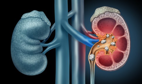 Những th&#243;i quen g&#226;y sỏi thận &#237;t người biết