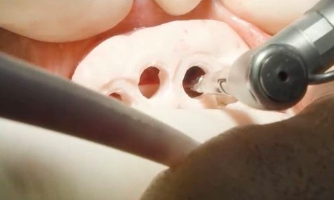 M&#225;ng định vị 3D Guide – Giảm nguy cơ biến chứng sau cấy gh&#233;p implant