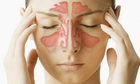 Thuốc trị viêm xoang mạn tính không có polyp mũi