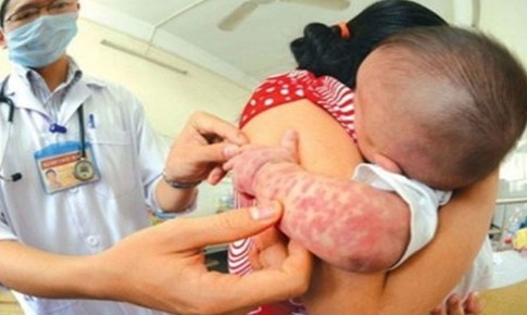 Đ&#227; c&#243; 78 ca sốt ph&#225;t ban nghi sởi, rubella, phải xử l&#253; triệt để ngay khi xuất hiện ca mắc