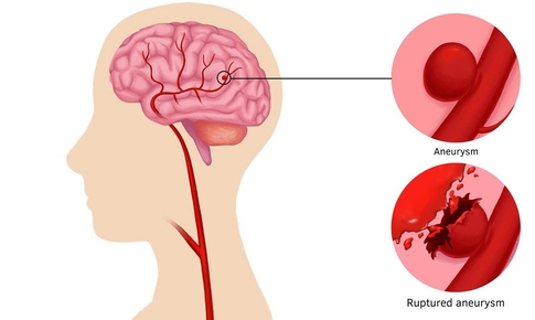 Đau đầu đột ngột coi chừng&#160;ph&#236;nh động mạch n&#227;o