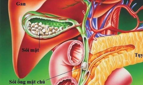 Sỏi t&#250;i mật c&#243; phải phẫu thuật kh&#244;ng?