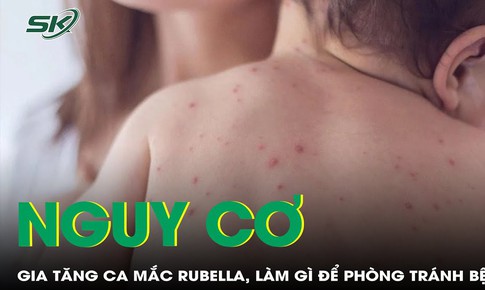 Bệnh truyền nhiễm Rubella nguy hiểm điều trị như thế n&#224;o?