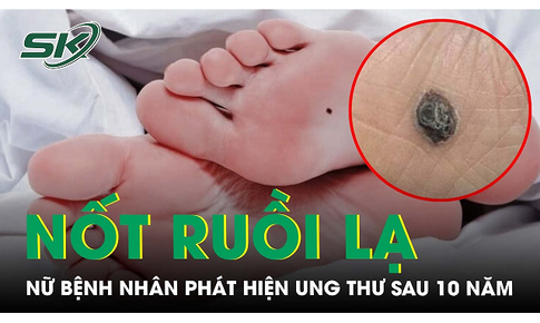 Ph&#225;t hiện ung thư từ nốt ruồi dưới l&#242;ng b&#224;n ch&#226;n