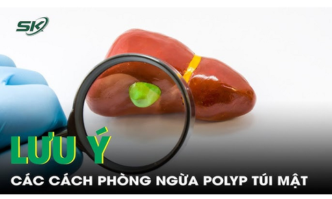 Lưu &#253; c&#225;c c&#225;ch ph&#242;ng ngừa polyp t&#250;i mật