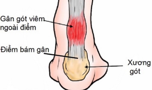 C&#225;ch ph&#242;ng ngừa tổn thương g&#226;n lớn nhất trong cơ thể khi chơi thể thao