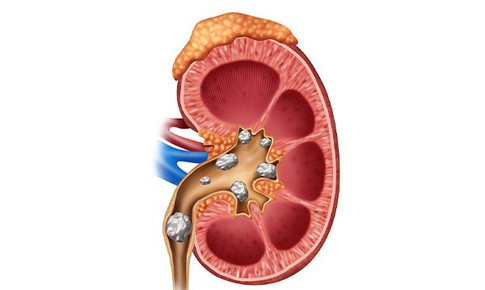 C&#225;c thuốc d&#249;ng trong điều trị sỏi thận