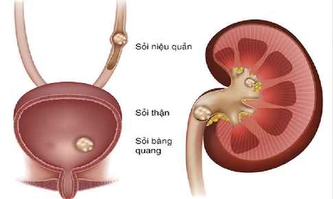 Sỏi tiết niệu: Nguy&#234;n nh&#226;n, triệu chứng, c&#225;ch điều trị v&#224; ph&#242;ng bệnh