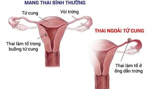 C&#226;u hỏi thường gặp về mang thai ngo&#224;i tử cung