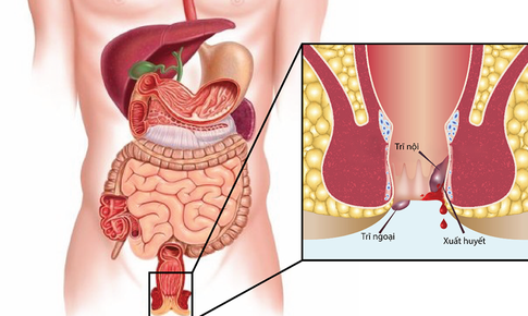 Bệnh trĩ nội hay trĩ ngoại nguy hiểm?