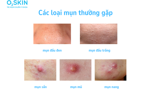 Ph&#226;n biệt c&#225;c loại mụn tr&#234;n mặt v&#224; c&#225;ch điều trị hiệu quả