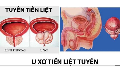 6 c&#225;ch ph&#242;ng u xơ tiền liệt tuyến cần biết