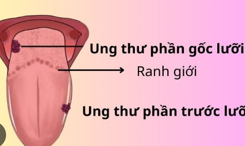 Người bệnh ung thư lưỡi n&#234;n tập luyện như thế n&#224;o?