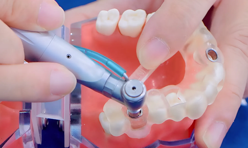 M&#225;ng hướng dẫn phẫu thuật Guideline - B&#237; quyết trồng răng implant an to&#224;n, kh&#244;ng biến chứng