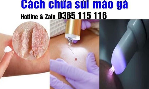 Phương ph&#225;p điều trị s&#249;i m&#224;o g&#224; hiệu quả tốt an to&#224;n