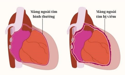 C&#226;u hỏi thường gặp li&#234;n quan đến bệnh vi&#234;m m&#224;ng ngo&#224;i tim