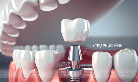 Chủ đề: C&#249;ng t&#236;m hiểu về trụ phục h&#236;nh giải phẫu c&#225; nh&#226;n h&#243;a trong trồng răng implant c&#244;ng nghệ mới