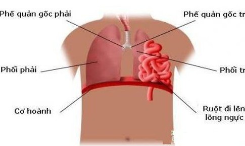 Thuốc điều trị bệnh tho&#225;t vị ho&#224;nh ở trẻ em