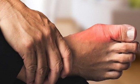 8 b&#237; quyết đơn giản để ph&#242;ng chống bệnh gout