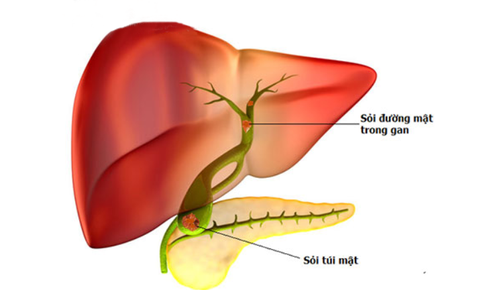 Biến chứng nguy hiểm của sỏi đường mật trong gan