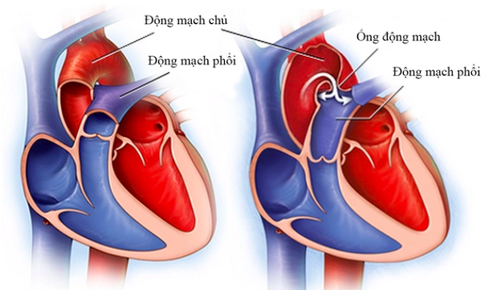 Vụ tử vong sau thay van động mạch chủ qua da: BV Bạch Mai đang l&#224;m r&#245; 3 b&#225;c sĩ tham gia