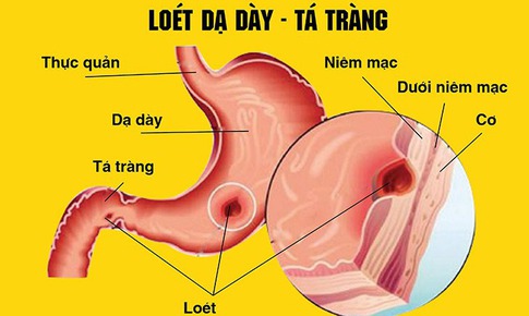 Lo&#233;t dạ d&#224;y t&#225; tr&#224;ng: Nguy&#234;n nh&#226;n, triệu chứng, ph&#242;ng ngừa v&#224; c&#225;ch điều trị