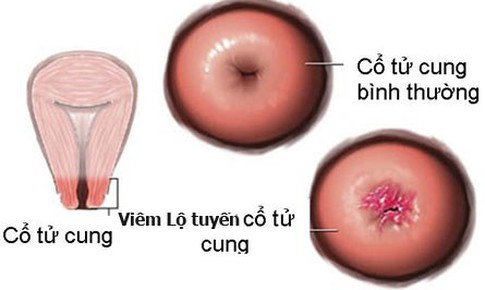 L&#224;m sao để biết c&#243; bị vi&#234;m lộ tuyến cổ tử cung?