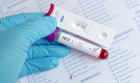 Giải ph&#225;p n&#224;o cho điều trị đồng nhiễm HIV/vi&#234;m gan C?