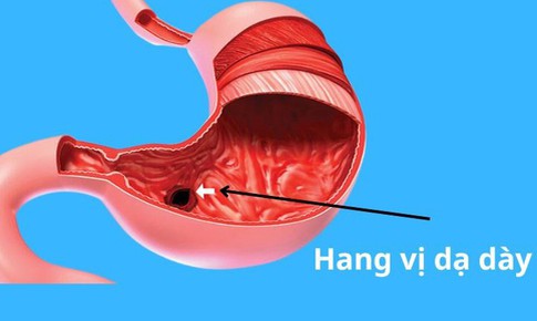 Vi&#234;m ni&#234;m mạc hang vị dạ d&#224;y: Nguy&#234;n nh&#226;n, triệu chứng, c&#225;ch điều trị v&#224; ph&#242;ng ngừa