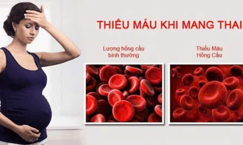 C&#226;u hỏi thường gặp về bệnh thiếu m&#225;u