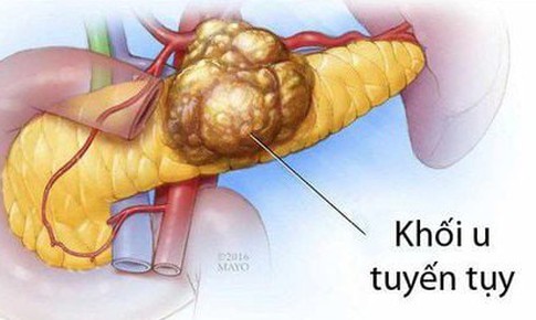 Ung thư tụy: Nguy&#234;n nh&#226;n, triệu chứng, c&#225;ch điều trị v&#224; ph&#242;ng bệnh