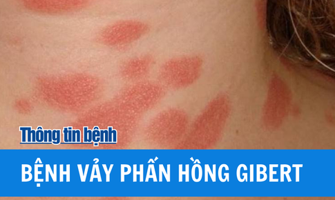 Bệnh vảy phấn hồng gibert l&#224; g&#236;? C&#225;ch xử tr&#237; hiệu quả