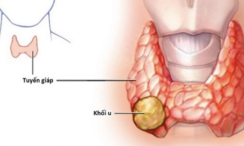 U tuyến gi&#225;p Tirads 3 c&#243; nguy hiểm kh&#244;ng v&#224; c&#225;ch điều trị thế n&#224;o?